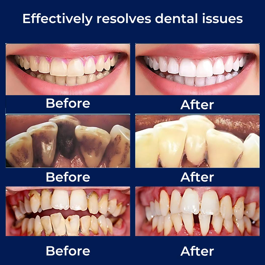 Ultrasonic Teeth Cleaner – Tartar Remover & Deep Plaque Remover for Teeth at Home