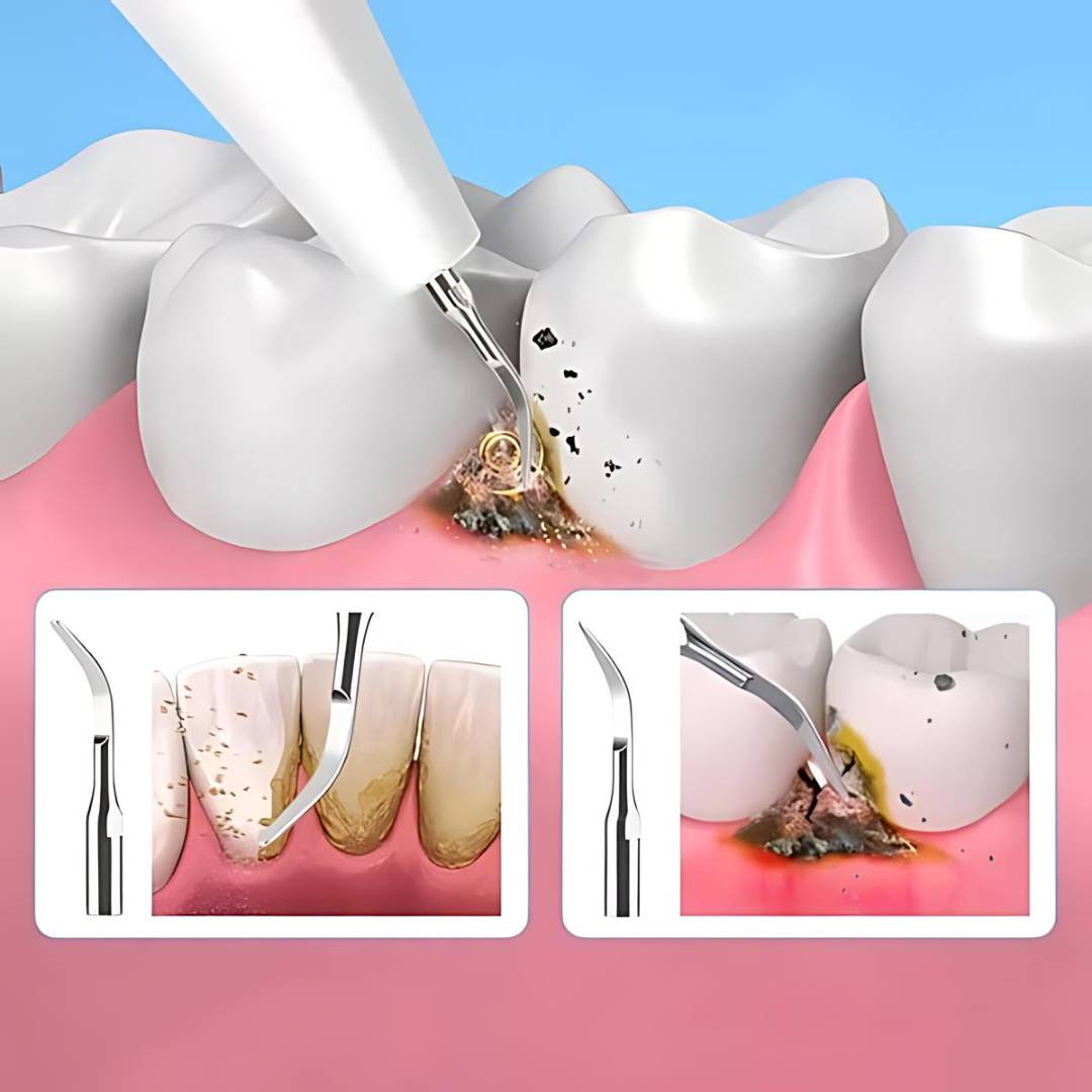 Ultrasonic Teeth Cleaner – Tartar Remover & Deep Plaque Remover for Teeth at Home