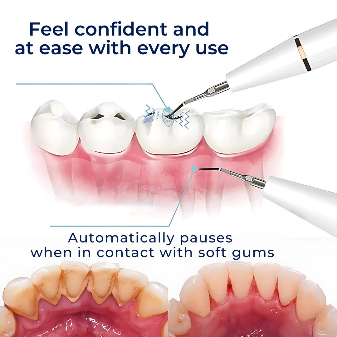 Ultrasonic Teeth Cleaner – Tartar Remover & Deep Plaque Remover for Teeth at Home