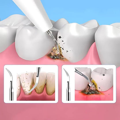 Ultrasonic Teeth Cleaner – Tartar Remover & Deep Plaque Remover for Teeth at Home